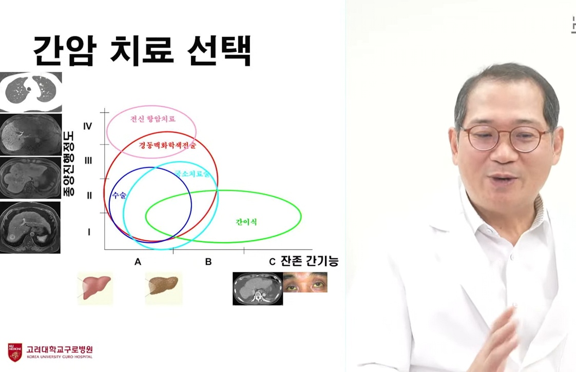 명의-지방간염-김지훈-교수-간암치료선택