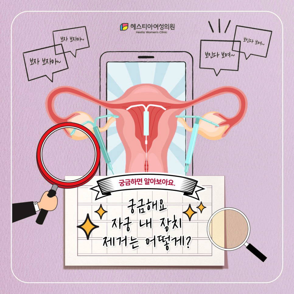 자궁 내 장치 제거는 어떻게?
