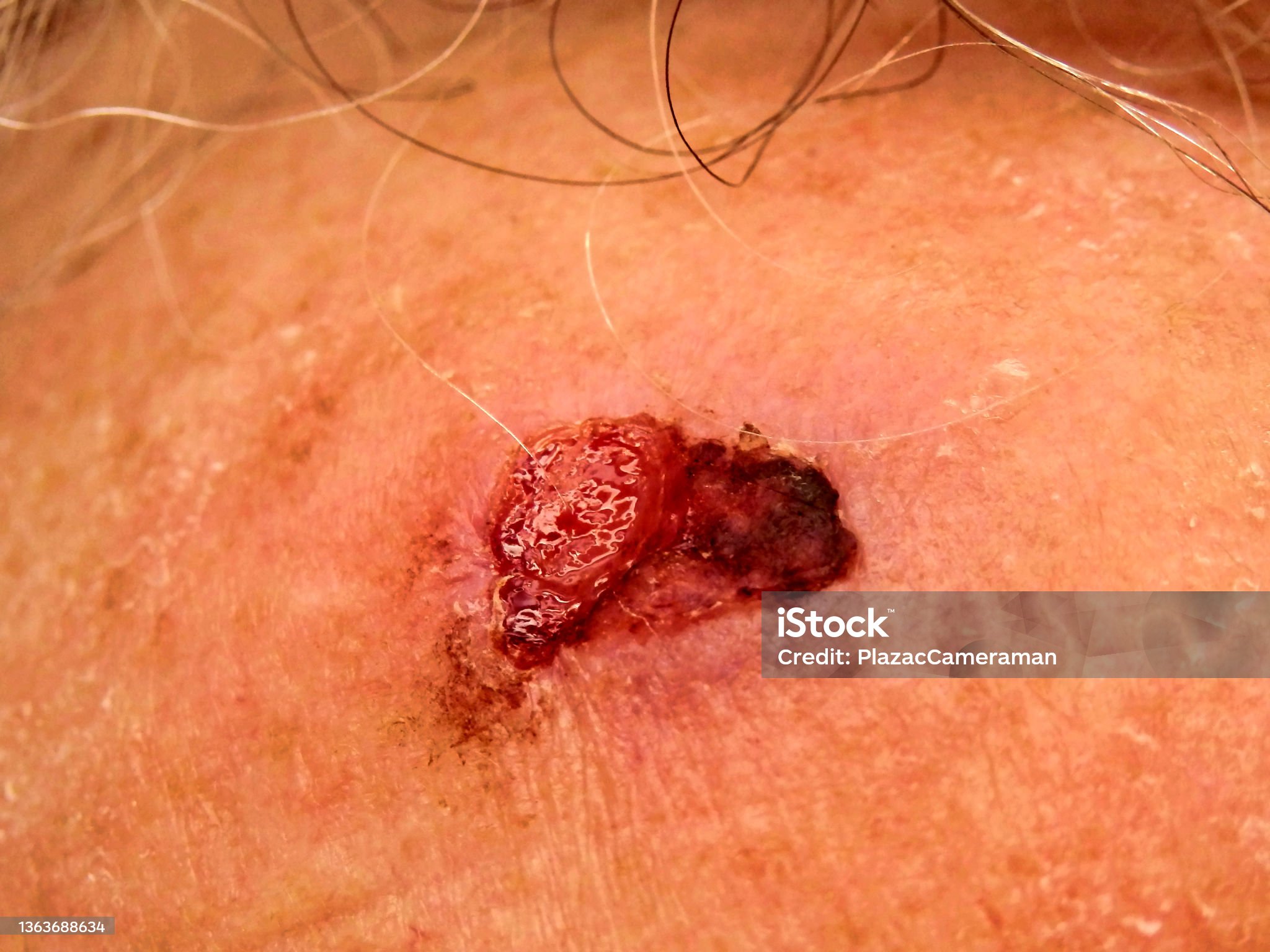 편평 세포암 관련 사진