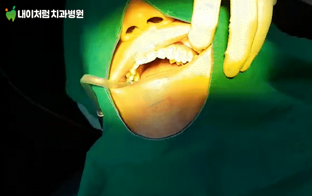 이수역치과 어금니 시림, 본드필 충전 과정