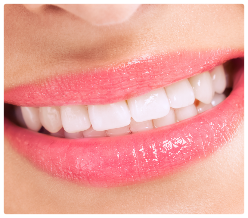 앞니 라미네이트 어떻게 진행될까?