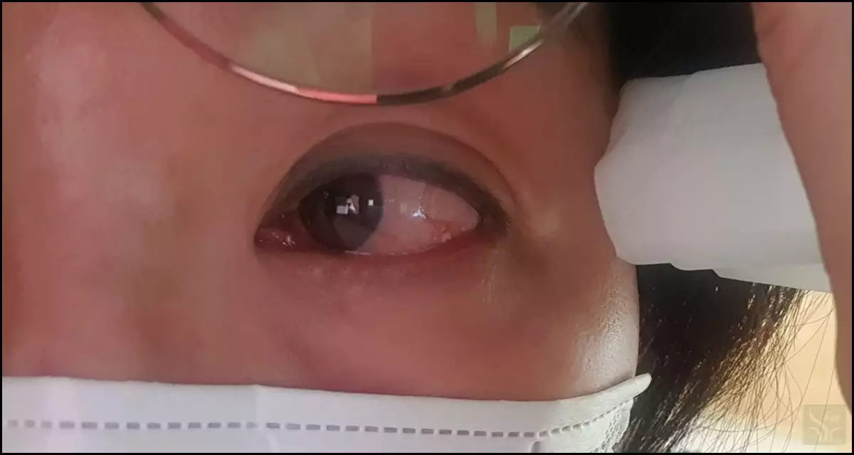 트리트먼트 들어가 충혈된 눈