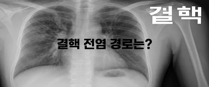 결핵의 전염성에 대해 알아보자