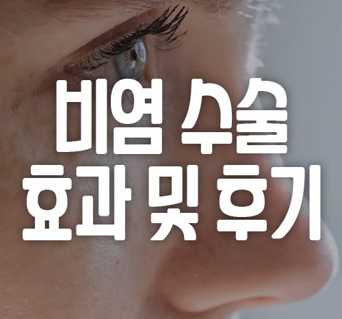 비염 수술 효과 후기