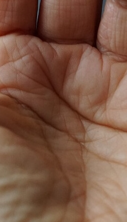 손가락수포대처법