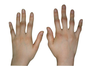 손가락 류마티스 관절염 증상