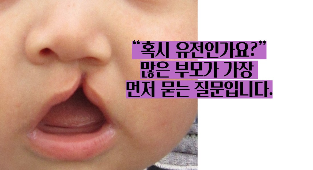 구순구개열 수술 유전