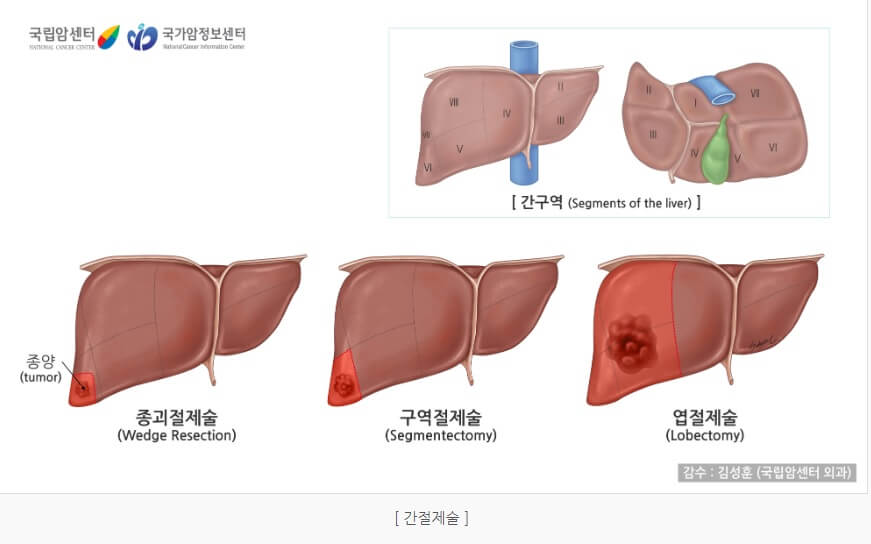 간암 치료 간 절제술