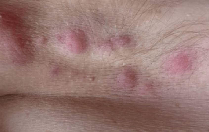 화농성 한선염 증상