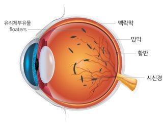 비문증 증상