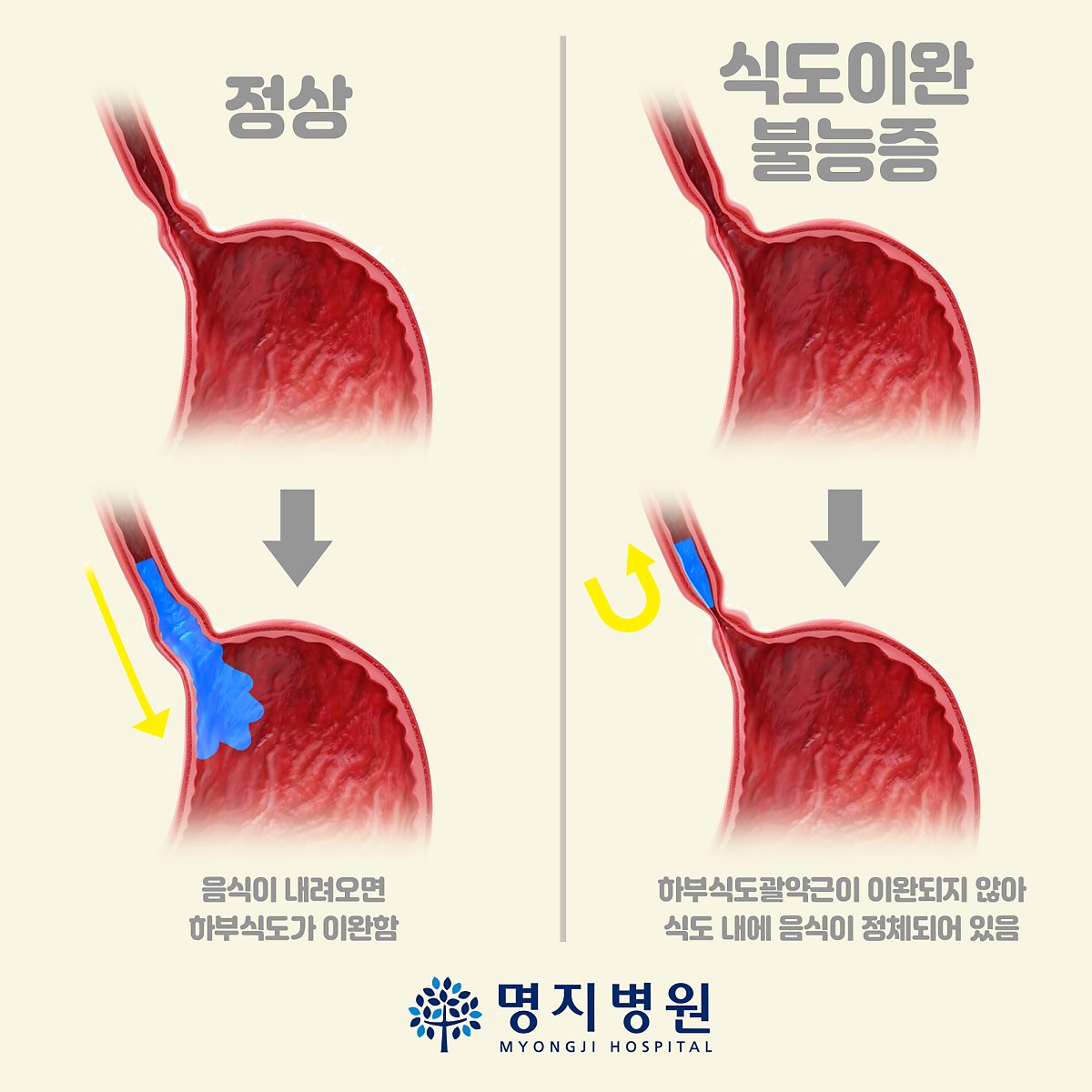 역류성 식도염 재발 이유&amp;#44; 약을 먹어도 계속 불편한 진짜 원인