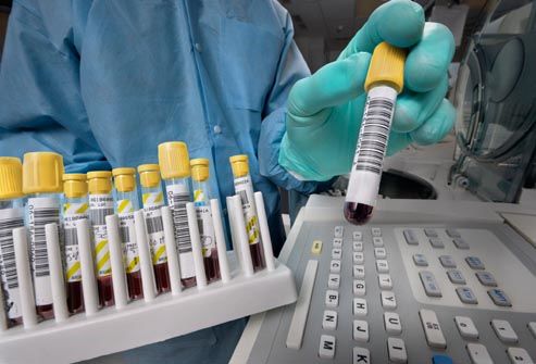Ferritin 수치