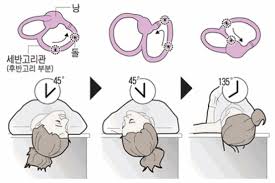 이석증 자가치료법