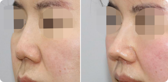 코 인중 축소수술