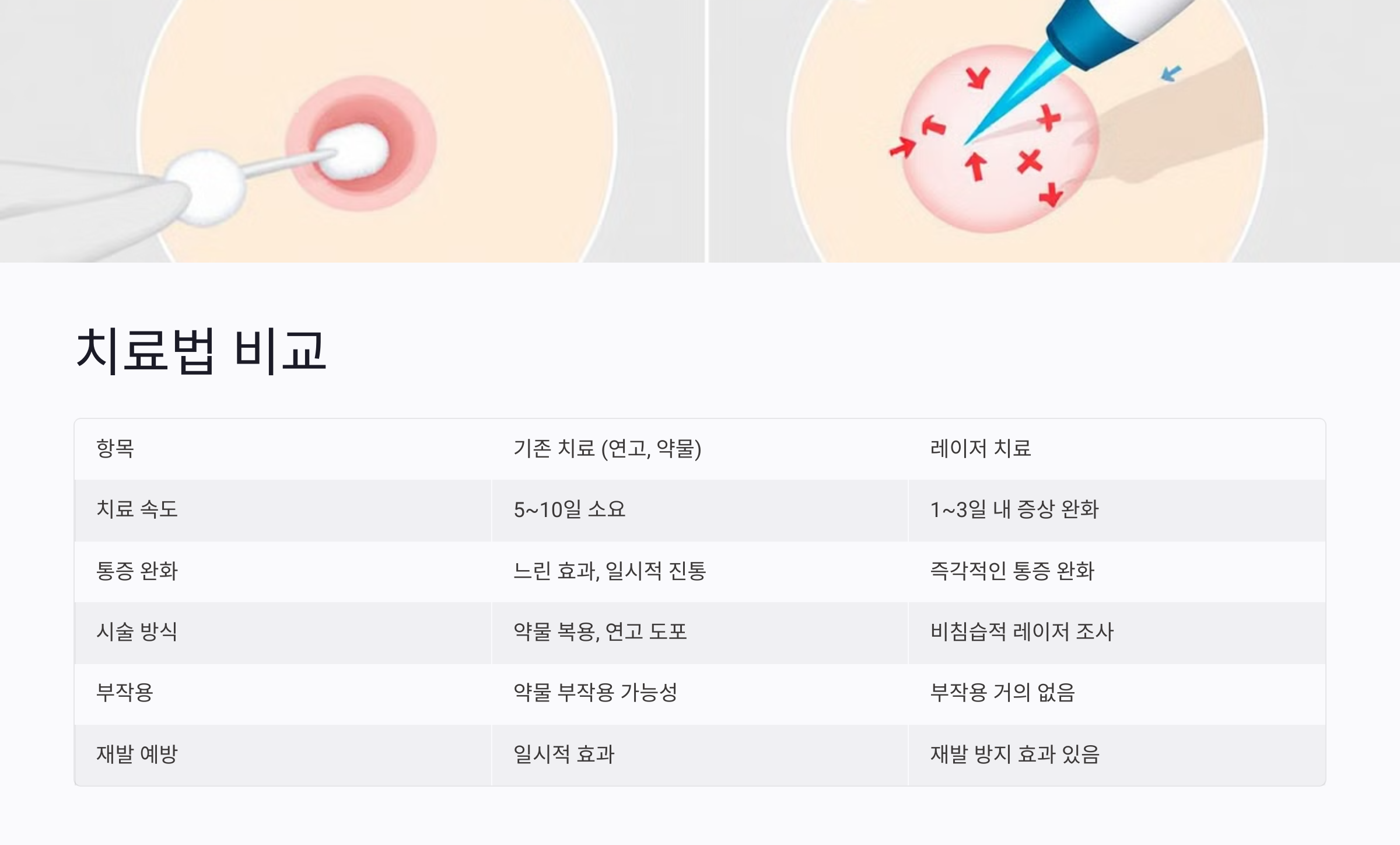 연고보다 빠르다? 구내염 치료법 비교