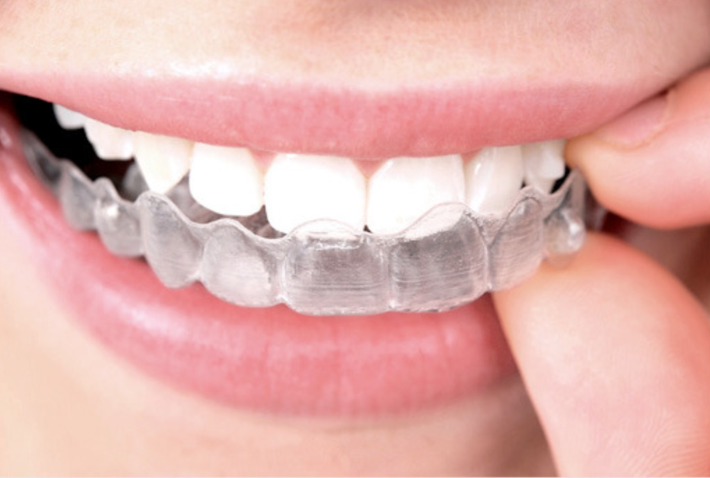 인비절라인 & 클라라AI 투명교정이란?