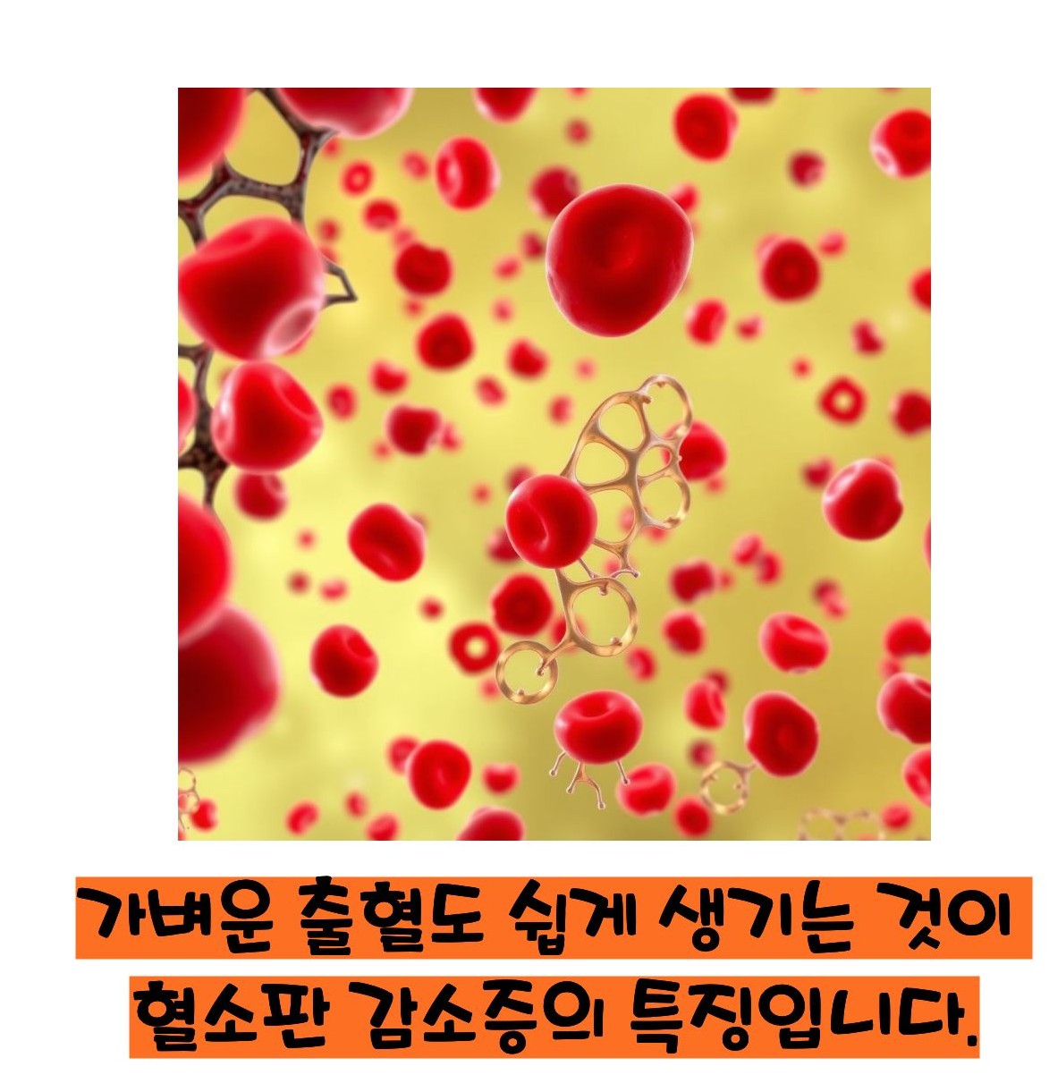 혈소판 감소증 증상