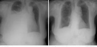 폐에 물이 차는 원인 증상 물참 관리 포인트에 대한 건강정보_12