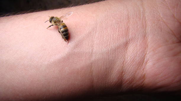 벌에 쏘였을 때 즉시 해야 할 응급 처치 단계별 가이드