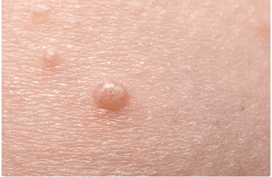 사마귀 완벽제거 방법&amp;#44;사마귀 생기는 이유&amp;#44;사마귀 종류 보통사마귀&amp;#44;사마귀 종류 편평사마귀&amp;#44;사마귀 종류 발바닥사마귀&amp;#44;사마귀 종류 성기사마귀&amp;#44;사마귀 종류 손발톱사마귀&amp;#44;집에서 사마귀 완벽제거하는 방법&amp;#44;집에서 사마귀 완벽제거하는 방법 살리실산 패치&amp;#44;집에서 사마귀 완벽제거하는 방법 살리실산 연고&amp;#44;사마귀연고 사용방법&amp;#44; 사마귀 완벽제거 방법 냉동치료&amp;#44; 사마귀 완벽제거 방법 레이저 치료&amp;#44;사마귀 완벽제거 방법 전기 소작법&amp;#44;사마귀 완벽제거 방법 수술적 제거&amp;#44; 사마귀 완벽제거 방법 면역치료&amp;#44; 사마귀 완벽제거 후 관리법&amp;#44; 사마귀 예방법&amp;#44;사마귀 예방법 손씻기&amp;#44;사마귀 예방법 발씻기&amp;#44; 사마귀 예방법공용물건사용 피하기&amp;#44; 사마귀 예방법 피부상처 관리&amp;#44; 사마귀 예방법 면연력 유지&amp;#44; 사마귀 예방법 성기 사마귀 예방&amp;#44; 성기사마귀 예방법 콘돔&amp;#44; 성기사마귀 예방법 HPV백신 접종&amp;#44; HPV 백신&amp;#44; 자궁경부암 예방