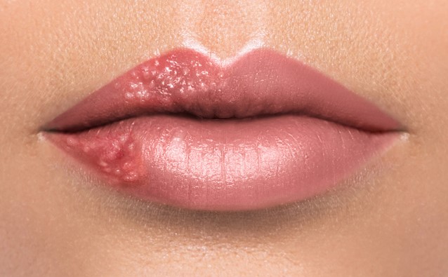 헤르페스 1형 이기는 방법