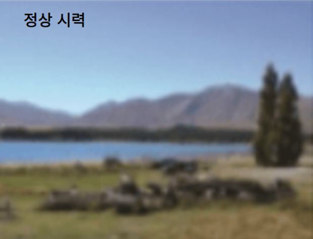 녹내장 증상 - 정상 시력