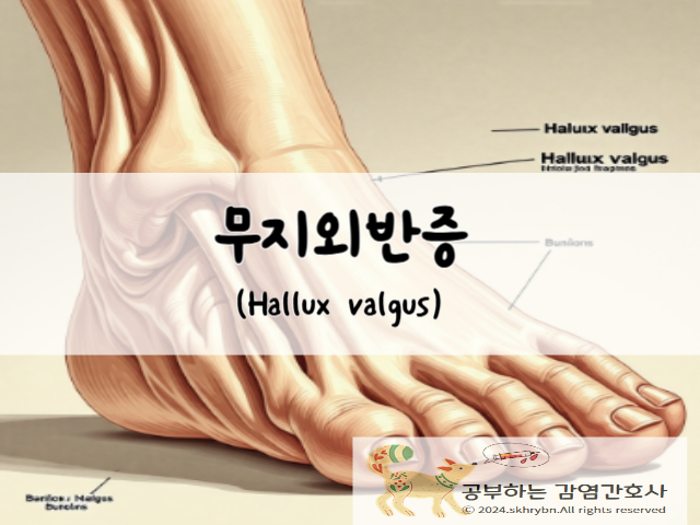 무지외반증(hallux valgus)의 원인 및 증상, 치료
