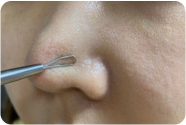 피지제거법 (여드름, 블랙헤드, 홈케어)