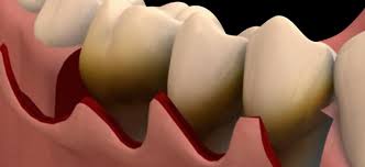 잇몸이 붓고 아플 때