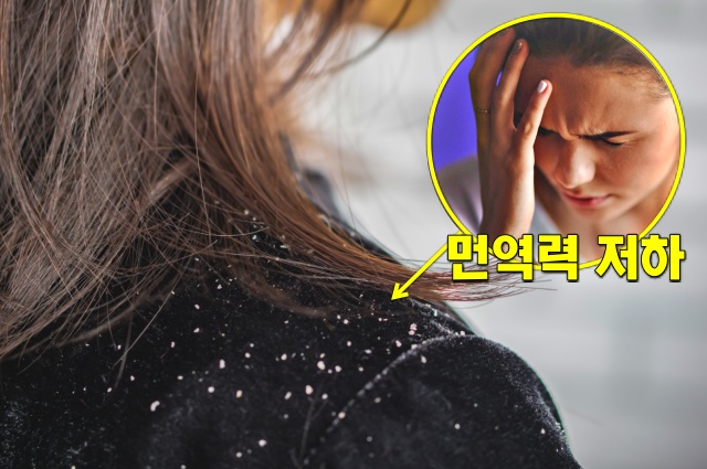 비듬이 생기는 원인 5가지 면역력 저하 증상, 건강 팁줌 매일꿀정보