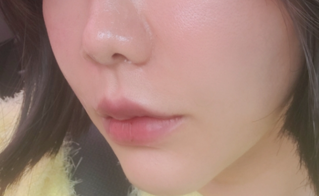 팔자 보톡스 후기