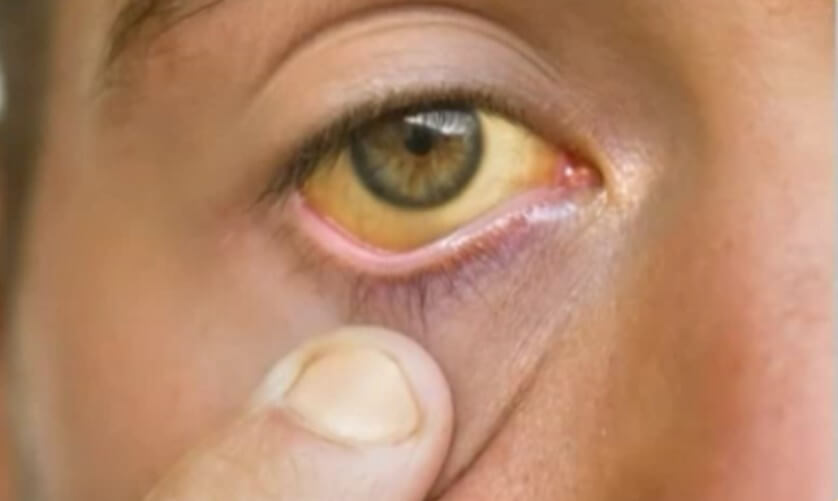 췌장암으로 인한 황달