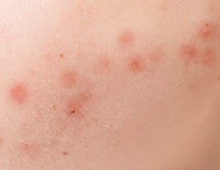 글루타치온 주의사항