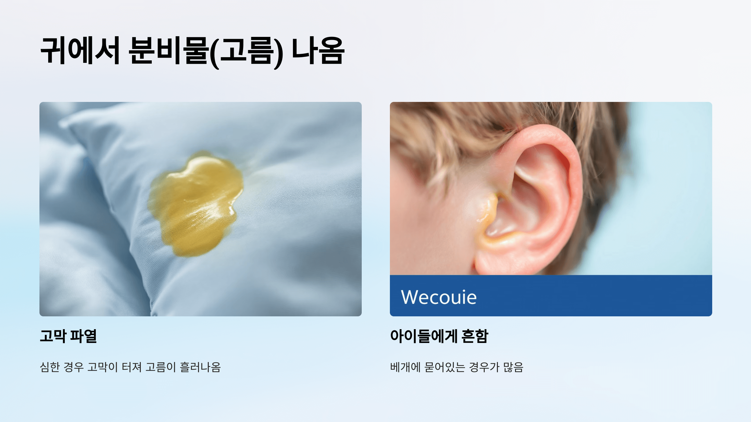 중이염과 관련된 사진입니다.