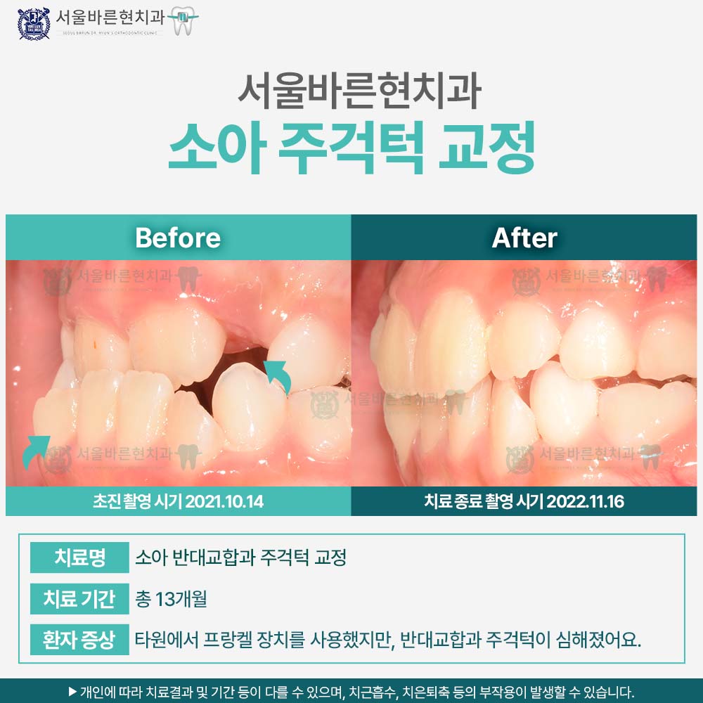 해운대치아교정