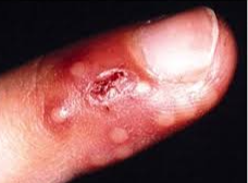 헤르페스 손발톱주위염(herpetic whitlow)