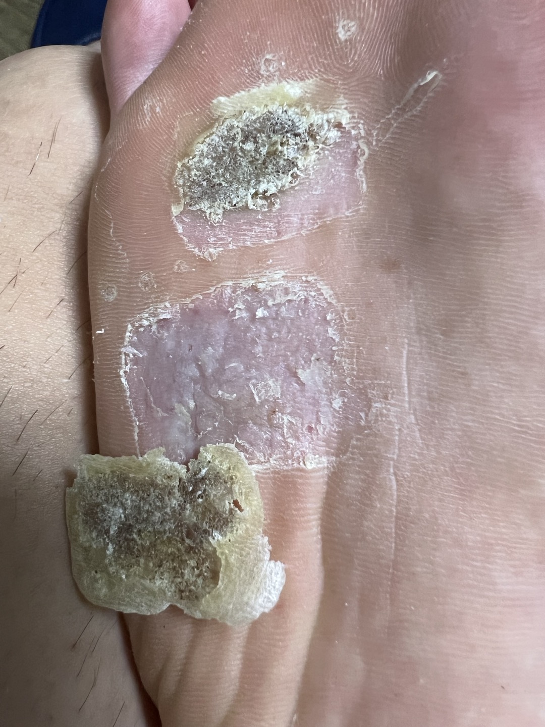 사마귀 냉동치료