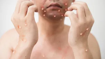 엠폭스 증상 예방접종 대처법 치료방법_7