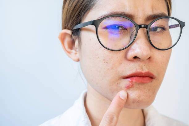 입술 포진 어느병원