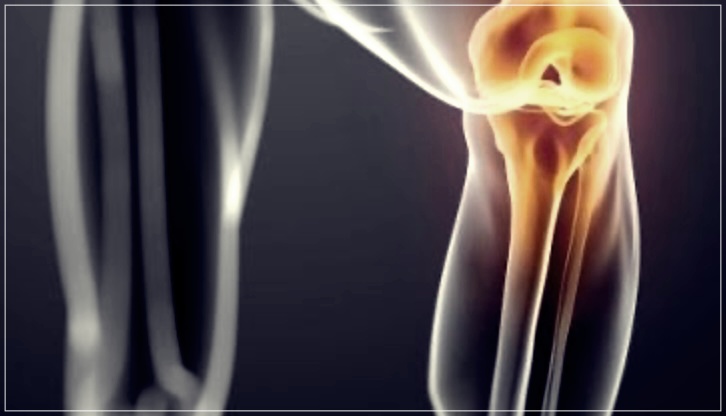 뼈암의 모든 것: 증상, 생존율, 좋은 음식, 통증, 전이, 및 검사