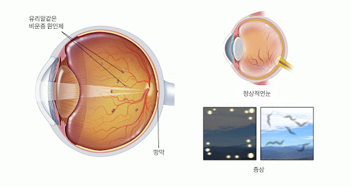 비문증