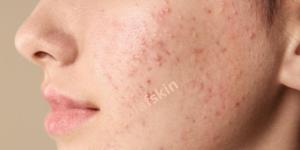 좁쌀 여드름 없애기