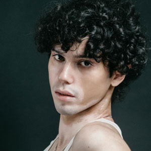 백반증 초기증상 - 백모증 동반