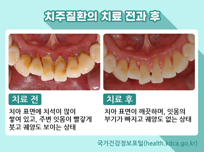 치주질환의 전과후