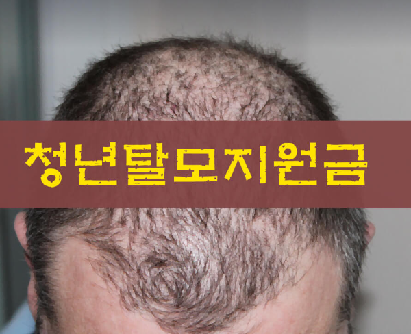 청년탈모지원금