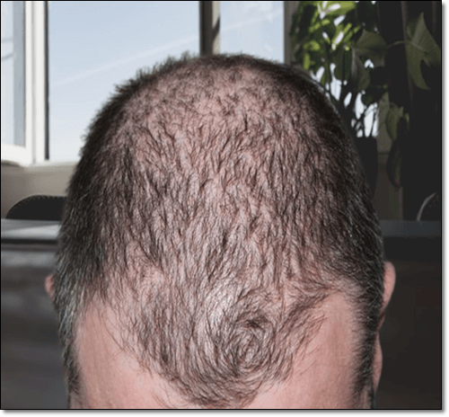 탈모증 남성