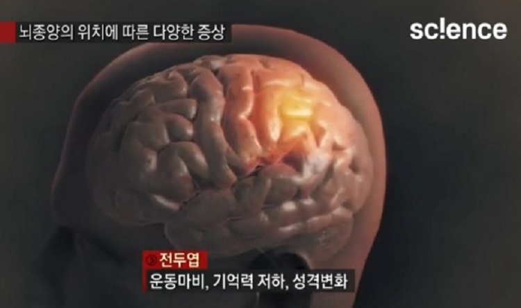 뇌종양위치에따른증상