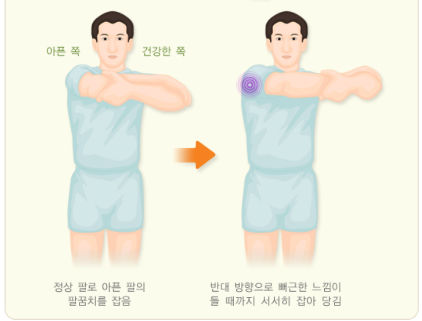 오십견 치료 운동법