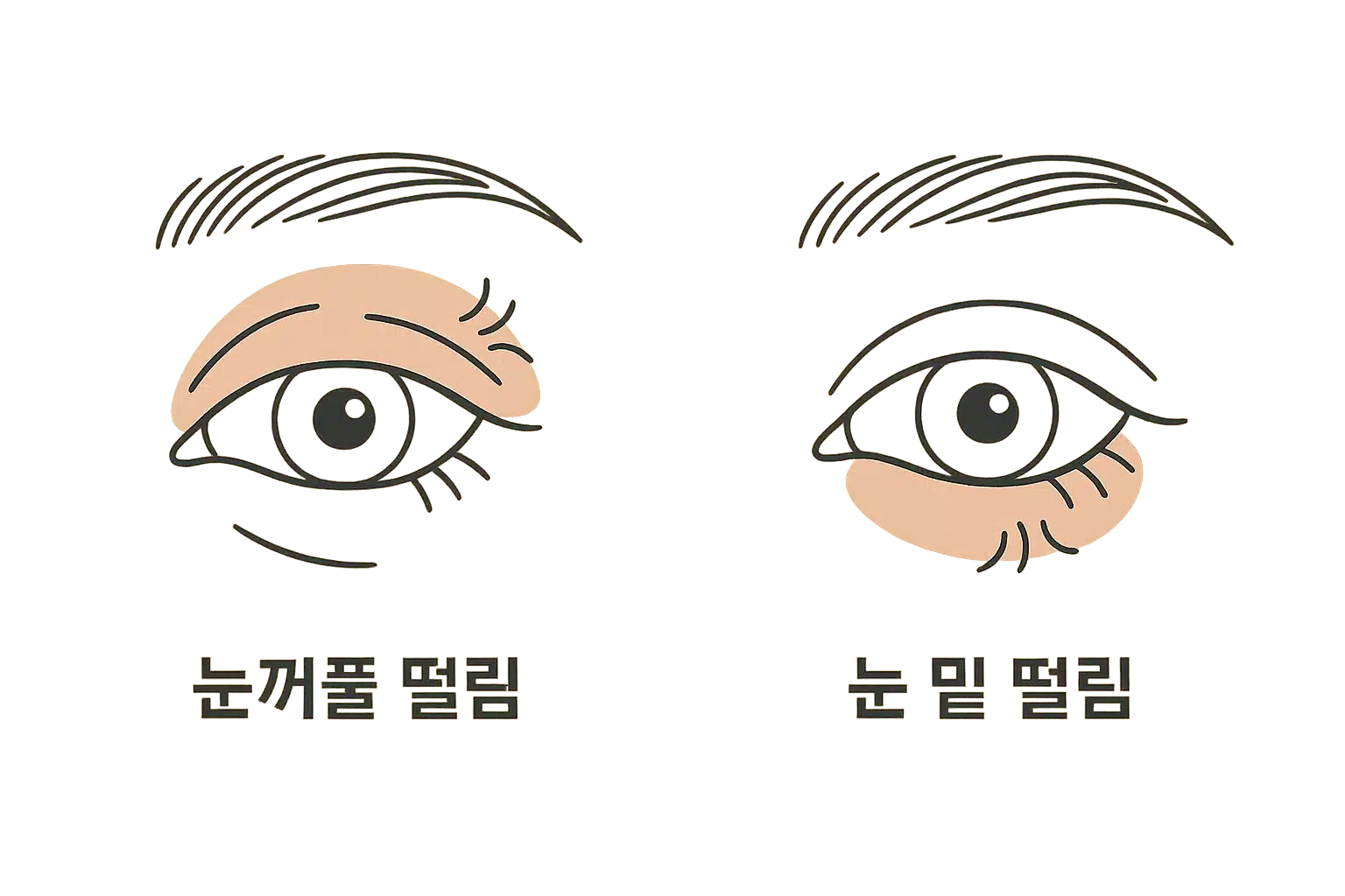 눈꺼풀 떨림 vs 눈 밑 떨림 비교