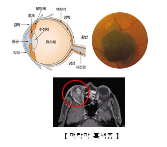 맥락막 흑색종 증상·원인·치료 - 눈 안에서 생기는 암, 조기 발견이 중요